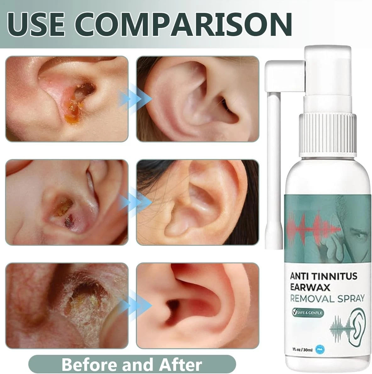 Anti Cochlear/Earwax Blockage Removal Spray, Ears(Pack Of 2)